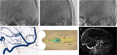 A Transvenous Endovascular Approach in Straight Sinus Has Minor Impacts on Chordae Willisii